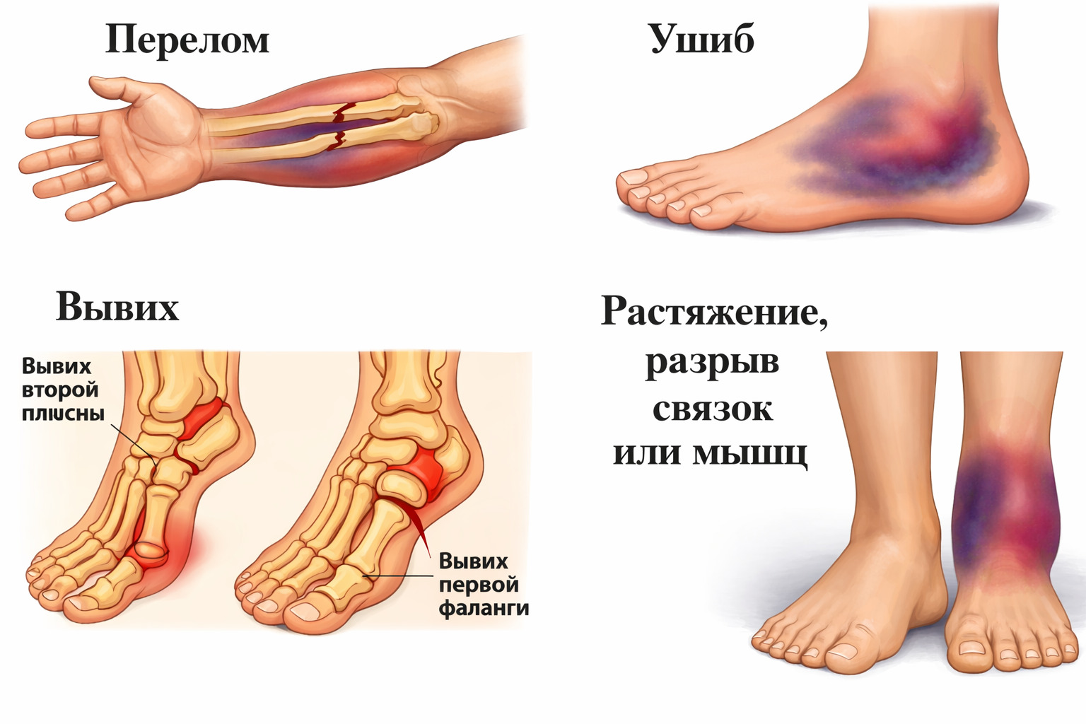 Ушиб пальца: как отличить его от перелома и оказать первую помощь - 1 Ушиб пальца: как отличить его от перелома и оказать первую помощь - 1