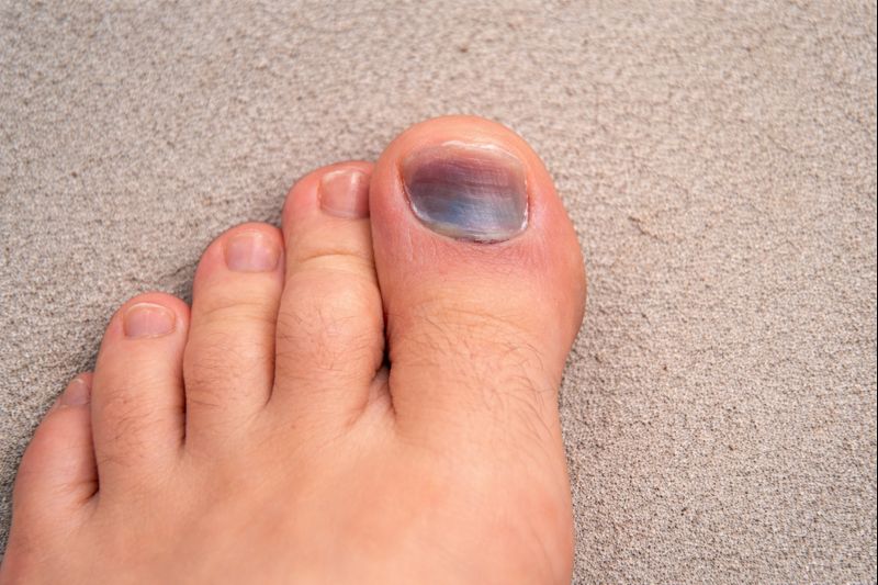 Ушиб пальца: как отличить его от перелома и оказать первую помощь - 2 Ушиб пальца: как отличить его от перелома и оказать первую помощь - 2